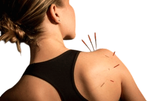 Dry Needling