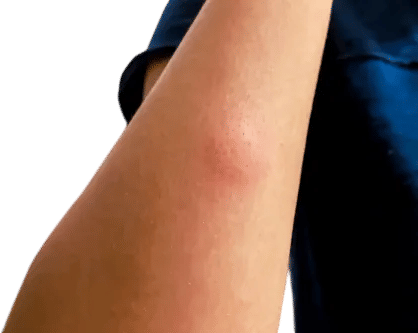 Moxa for mosquito bites