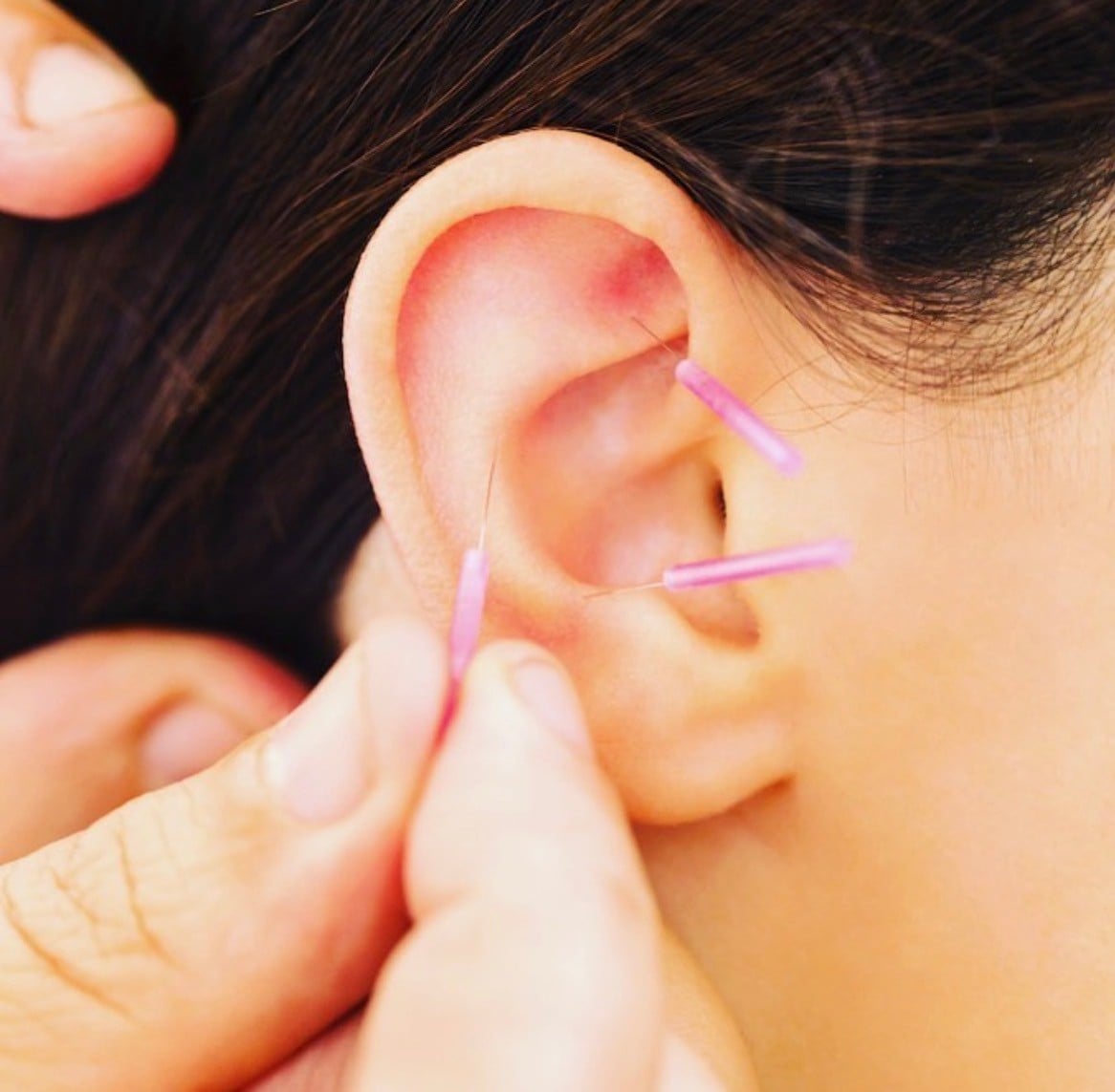 Acupuncture for Migraines