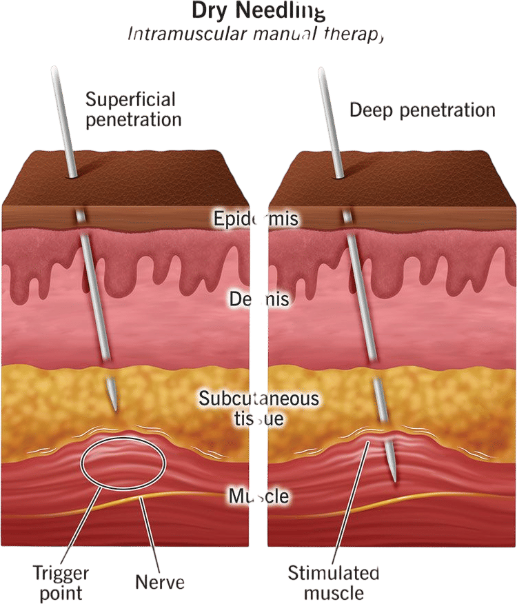 Trigger Point Dry Needling