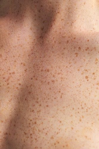 Freckling>Tanning