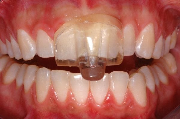 “NTI device” (mini mouth guard)