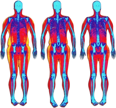 DEXA Scan