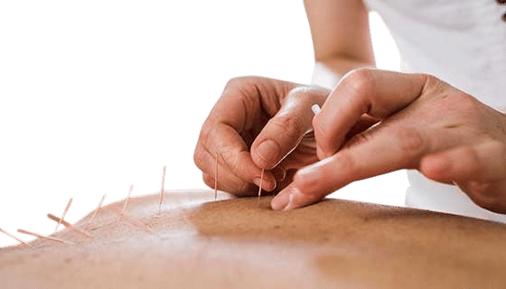 Acupuncture