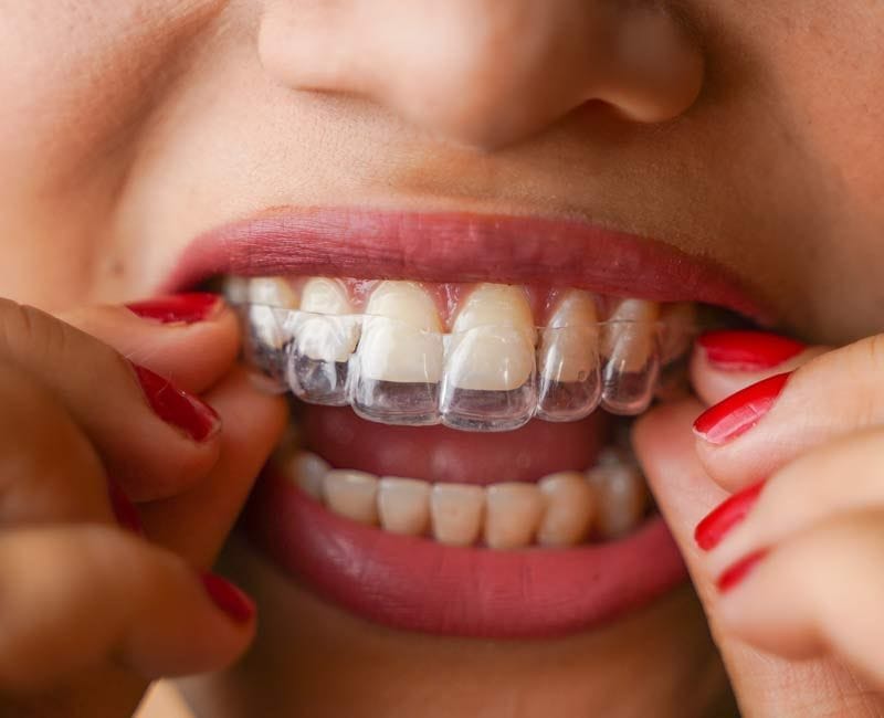 Wear your Retainer