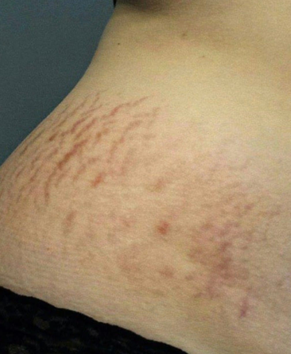 Stop having silly names for your stretch marks