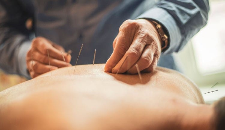 Accupuncture