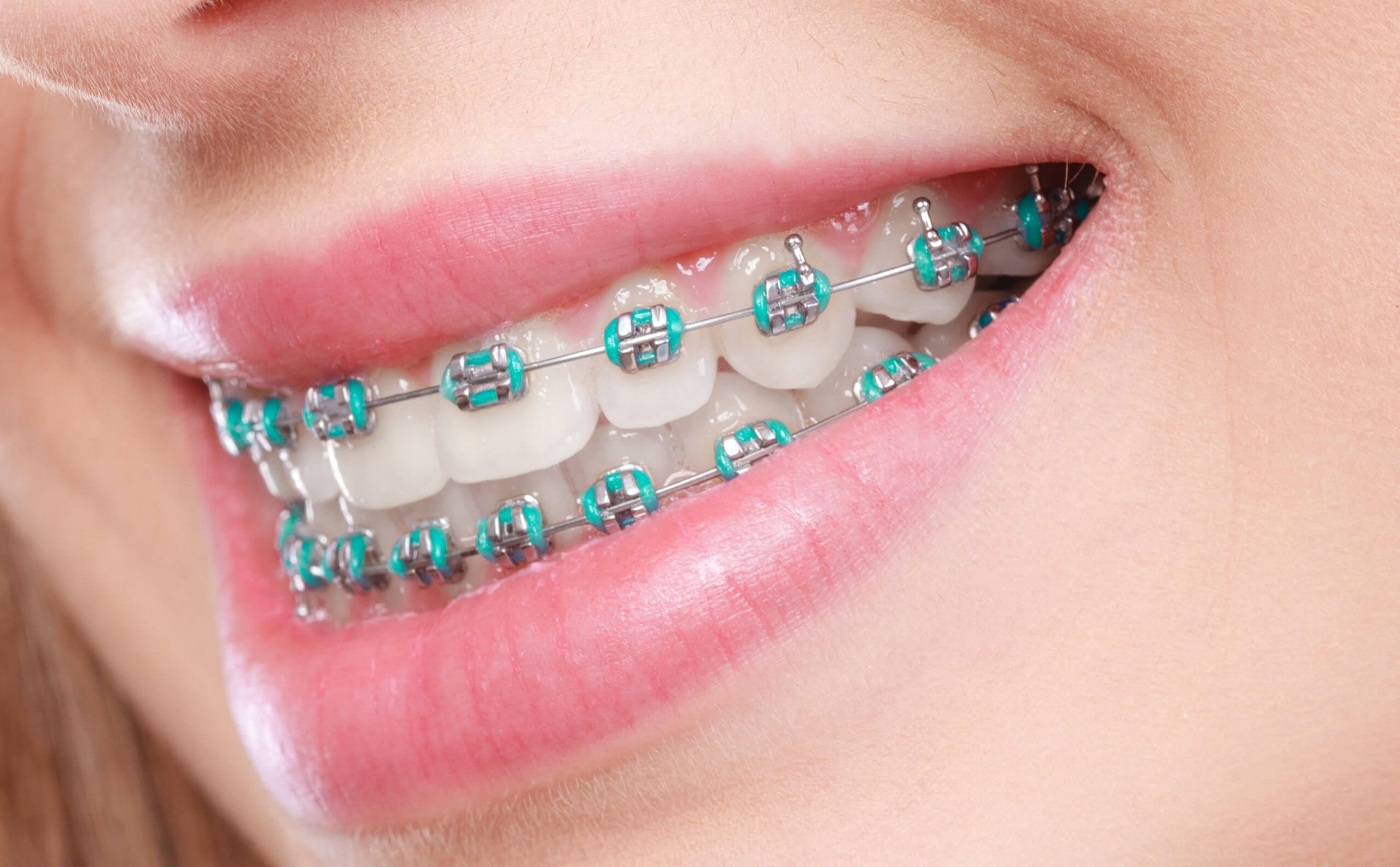 Old School Braces