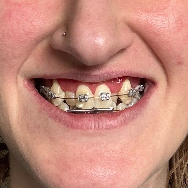 Things I will be enjoying when my adult braces come off my teeth