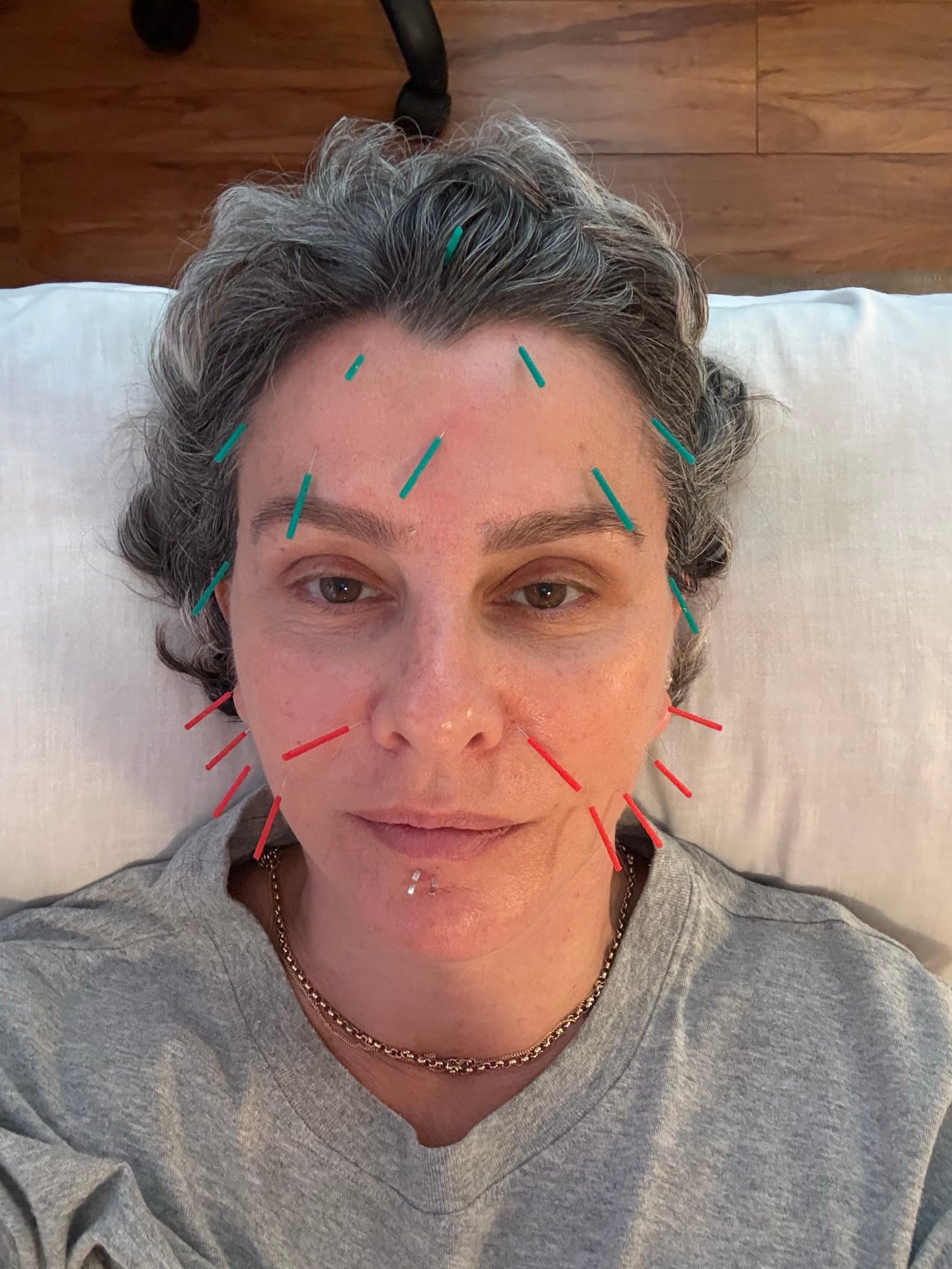 Facial Acupuncture
