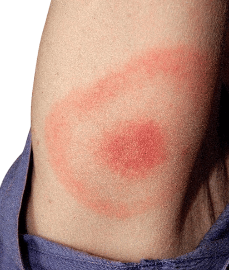 Getting Lyme Disease