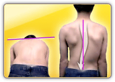 scoliosis test