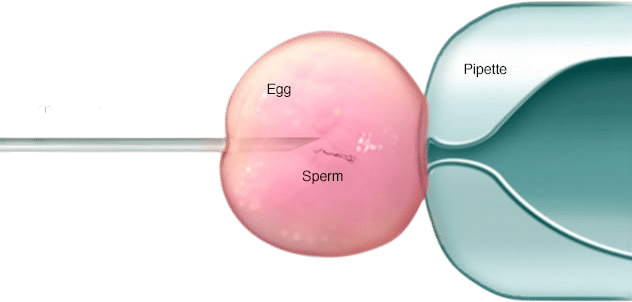 IVF