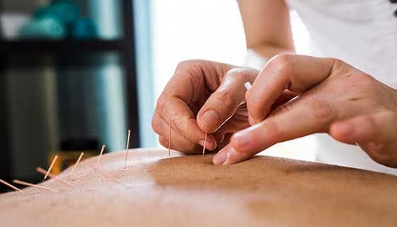 acupuncture